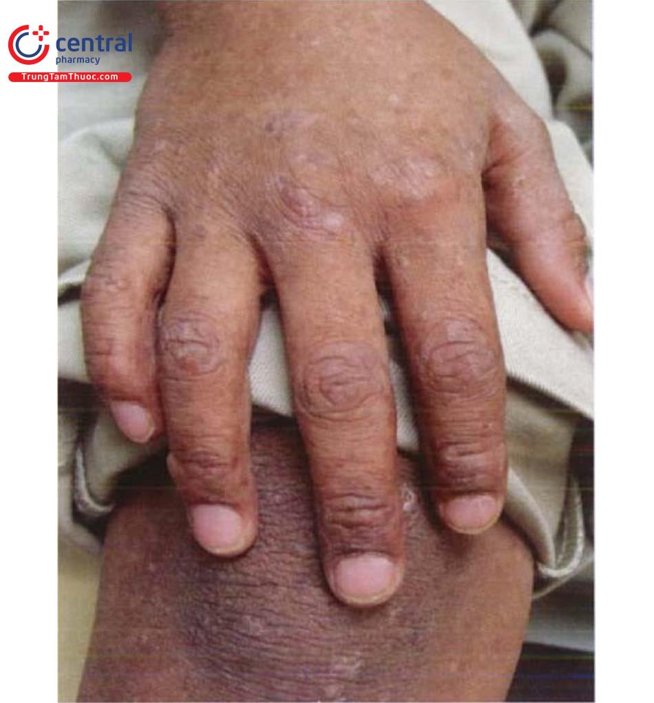 Các loại tổn thương tăng sắc tố da và bệnh lý thường gặp 