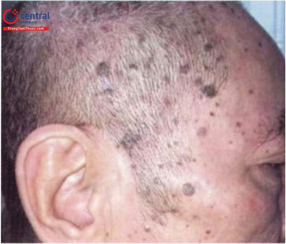 Các loại tổn thương tăng sắc tố da và bệnh lý thường gặp  