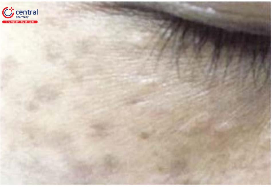 Các loại tổn thương tăng sắc tố da và bệnh lý thường gặp  