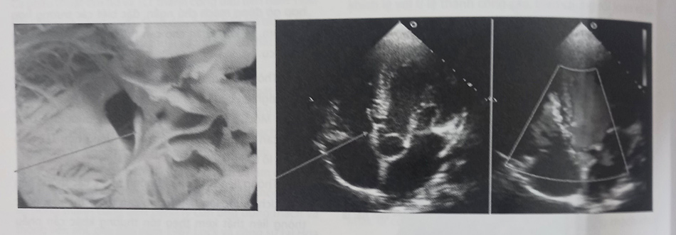 Hình 33.2. Hình ảnh gờ động mạch chủ (mũi tên chỉ) của thông liên thất phần quanh màng trên siêu âm tim ở mặt cắt 5 buồng