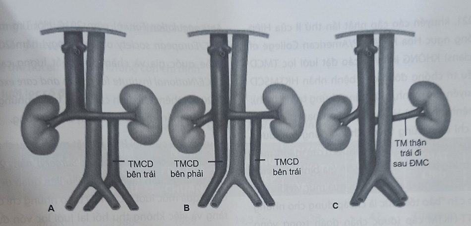 Hình 58.1. Biến thể giải phẫu tĩnh mạch chủ dưới: (A) Tĩnh mạch chủ dưới bên trái, (B) Hai tĩnh mạch chủ dưới, (C) Tĩnh mạch thận trái đi sau động mạch chủ bụng