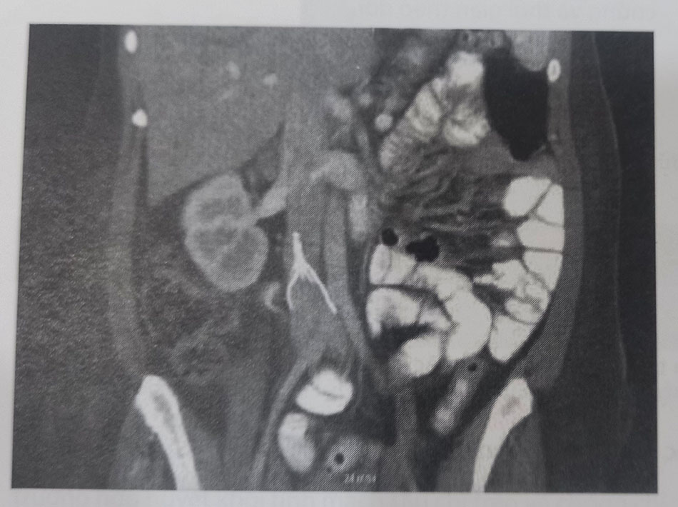Hình 58.9. Lưới lọc tĩnh mạch chủ dưới thâm nhập vào động mạch chủ bụng và tĩnh mạch chậu gốc