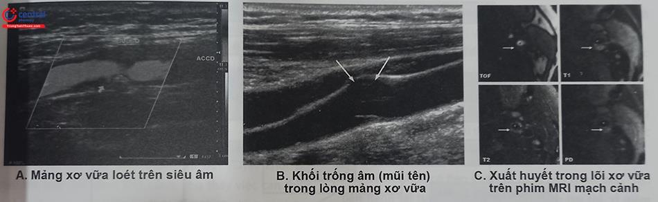 Hình 29.2. Một số hình ảnh tổn thương mảng xơ vữa động mạch cảnh. A. Mảng xơ vữa loét trên siêu âm, B. Khối trống âm (mũi tên) trong lòng mảng xơ vữa, C. Xuất huyết trong lõi xơ vữa trên phim MRI (cộng hưởng từ) động mạch cảnh.