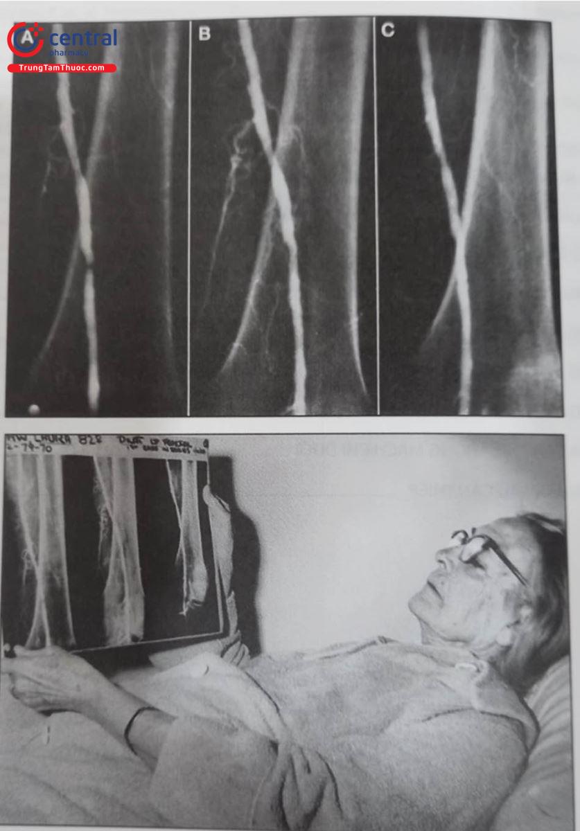 Hình 28.1. Hình ảnh chụp động mạch chi dưới qua da đầu tiên của bác sĩ Charles Dotter và bệnh nhân Laura Shaw.