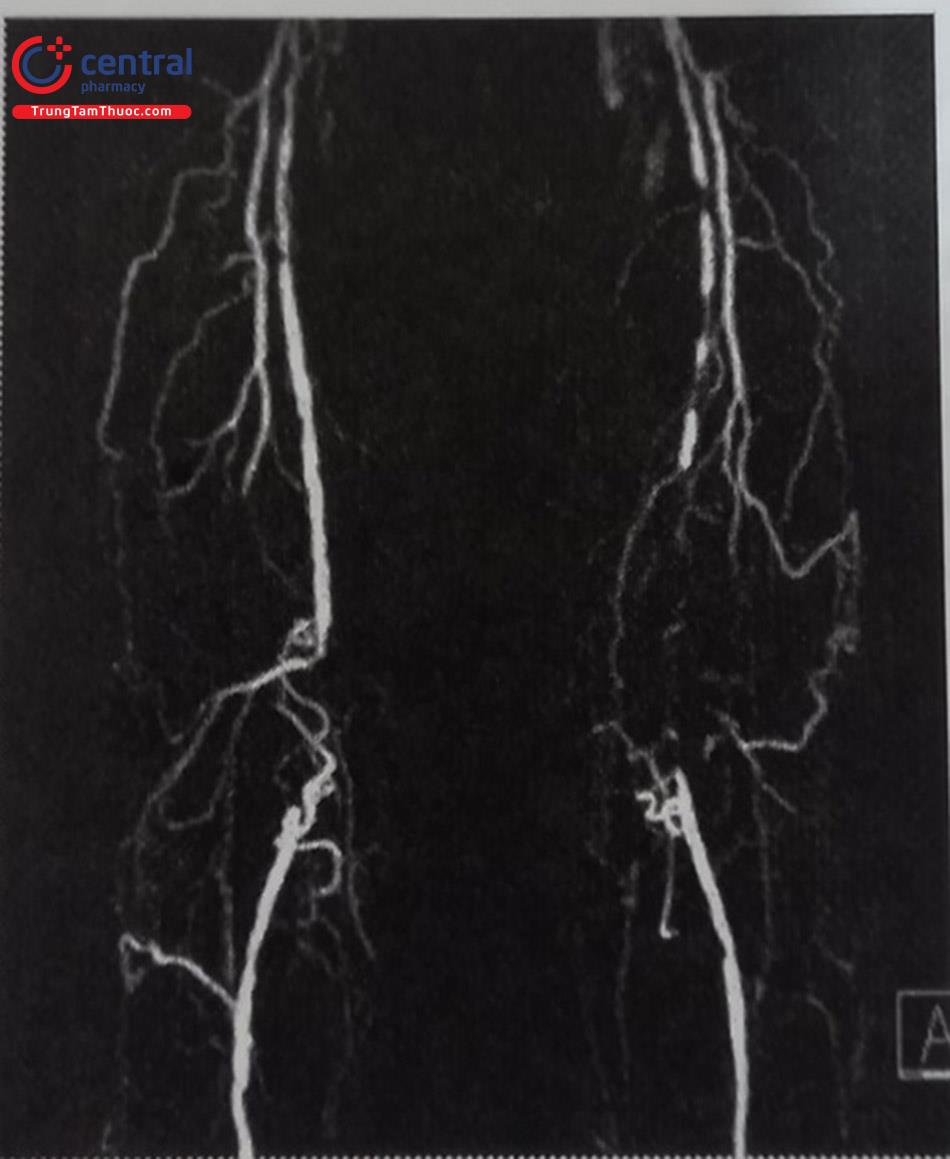 Hình 28.3. Hình ảnh tắc hoàn toàn động mạch đùi nông do xơ vữa mạch máu. Các đoạn mạch xơ vữa lan tỏa, kèm theo rất nhiều tuần hoàn bàng hệ.