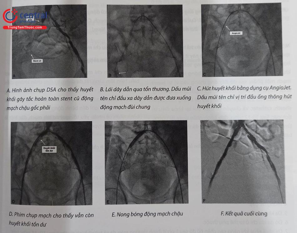  Hình 28.5. Ca lâm sàng tắc cấp stent động mạch chậu gốc phải, được hút huyết khối bằng AngioJet (nguồn: Viện Tim mạch Việt Nam).