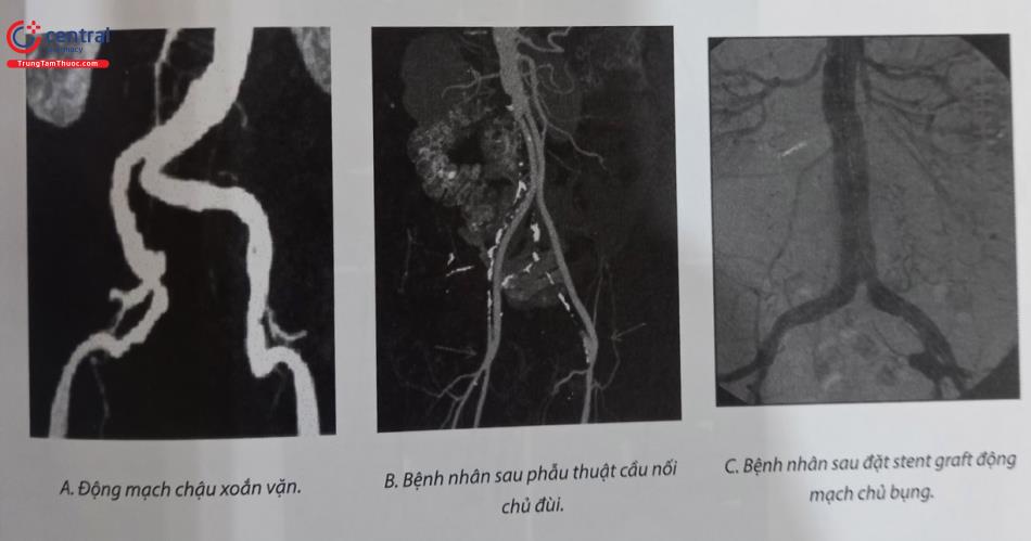 Hình 28.9. A, B, C. Hình ảnh minh họa các tổn thương không thích hợp khi sử dụng đường vào động mạch đùi ngược dòng  