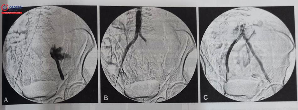 Hình 28.27. Ca lâm sàng vỡ động mạch chậu. A: Chụp mạch cho thấy hình ảnh thoát thuốc cản quang do vỡ động mạch chậu ngoài, B: Nong bóng vị trí vỡ động mạch chậu, chụp ĐMC bụng cho thấy bóng bơm căng đã bít kín lòng mạch, C: Đặt stent có màng bọc, chụp kiểm tra không còn hình ảnh thoát thuốc.