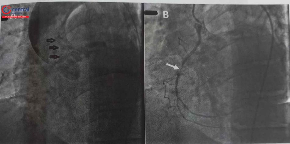 Hình 24.5. Chụp động mạch vành xác định vị trí xuất phát cao của động mạch vành phải (RCA). (A) chụp không chọn lọc động mạch chủ thấy bóng RCA xuất phát cao (hình mũi tên đen là bóng cản quang của RCA ). (B) Chụp chọn lọc bằng ống thông JL 3.0-6F xác định vị trí xuất phát cao của RCA, có hẹp khít đoạn giữa RCA ( mũi tên trắng).