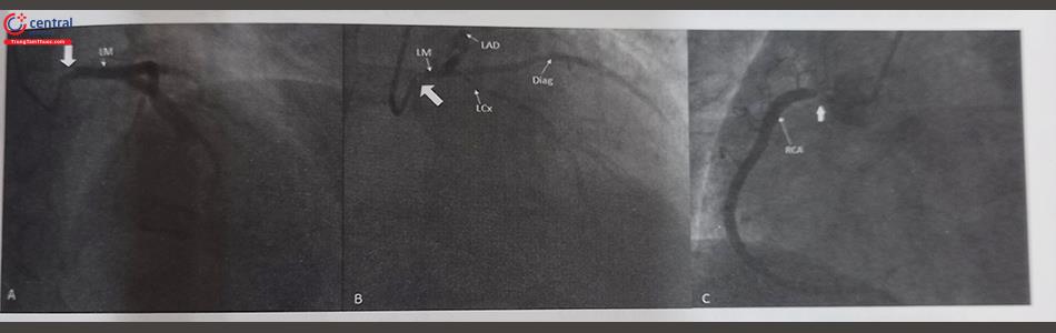 Hình 24.7. Minh hoạ tổn thương hẹp khít lỗ vào (mũi tên trắng to) LM. (A,B) và lỗ vào RCA (C) trên phim chụp động mạch vành. Chú thích: RCA: Động mạch vành phải; LCx: Động mạch mũ; LAD: Động mạch liên thất trước, LM: thân chung động mạch vành trái. Dig: động mạch liên thất trước.