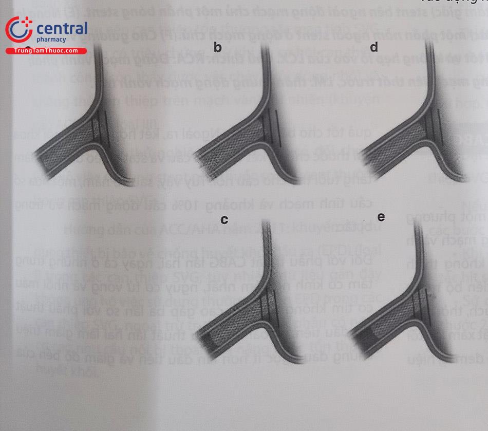 Hình 24.10. Vị trí đặt stent tại lỗ vào. Vị trí thích hợp (a) và không thích hợp (b,c,d,e) của stent lỗ vào: (a) vị trí đặt stent tối ưu: toàn bộ đầu gần của stent nằm trong vùng lỗ vào-động mạch chủ.(b,c) ít nhất một cạnh của stent (trên hoặc dưới) nằm trong vùng lỗ vào-động mạch chủ. (d) đầu gần stent nằm hoàn toàn phía sau vùng lỗ vào-động mạch chủ (stent hụt lỗ). (e) stent quá lồi vào động mạch chủ (toàn bộ đầu gần của stent nằm hoàn toàn phía trước vùng lỗ vào-động mạch chủ.