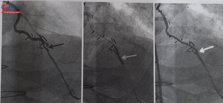 Hình 24.14. Can thiệp cầu nối LIMA. Mũi tên đen: hẹp 90% vị trí nối giữa LIMA và LAD. Mũi tên xám: nong bóng áp lực cao 2,0x 15 mm. Mũi tên trắng: đặt stent DES 2,5x 18 mm.