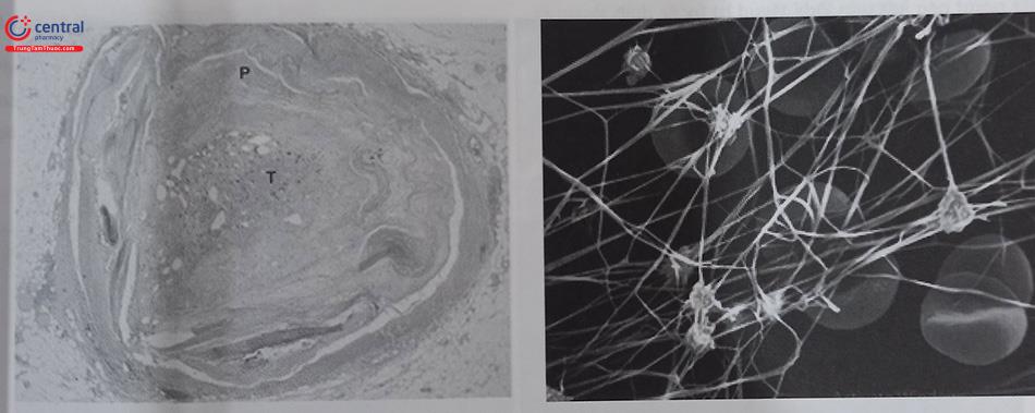 Hình 24.19. (A): Mặt cắt ngang của động mạch vành phải bị tắc bởi mảng xơ vữa phức tạp, vôi hóa (P) và tổ chức huyết khối (T). (B): phóng to huyết khối nhờ kính hiển vi điện tử, lưu ý các sợi fibrin dày và mỏng đan chéo nhau, tạo ra một hệ thống mạng nhện cho cấu trúc huyết khối; tiểu cầu (màu trắng) và hồng cầu (màu xám) được gắn vào mạng fibrin.