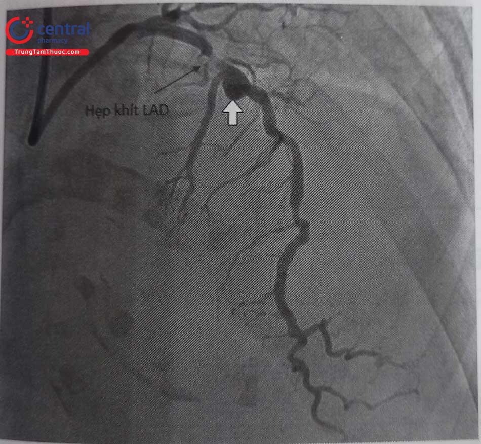 Hình 24.31. Chụp động mạch vành qua da: Phình mạch vành (mũi tên trắng) và tổn thương hẹp khít ngay trước phình ở bệnh nhân hội chứng vành cấp.