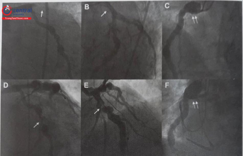 Hình 24.34. Hình ảnh minh hoạ nhồi máu cơ tim trên nền mạch vành bị phình giãn và tiến triển của mạch phình. (A): tắc hoàn toàn LAD (vị trí mũi tên). (B): hình ảnh chụp sau đặt stent đoạn gần LAD (vị trí mũi tên). (C): phình đoạn đầu RCA (mũi tên kép). Hình D,E,F là chụp lại mạch vành sau 4 năm: stent cũ thông tốt nhưng có hẹp nặng đoạn giữa LCx (mũi tên hình D), hẹp nặng cuối đoạn đầu LAD (mũi tên hình E) và phình mạch vành mở rộng hơn ở đoạn đầu RCA (mũi tên kép hình F) so với 4 năm trước.