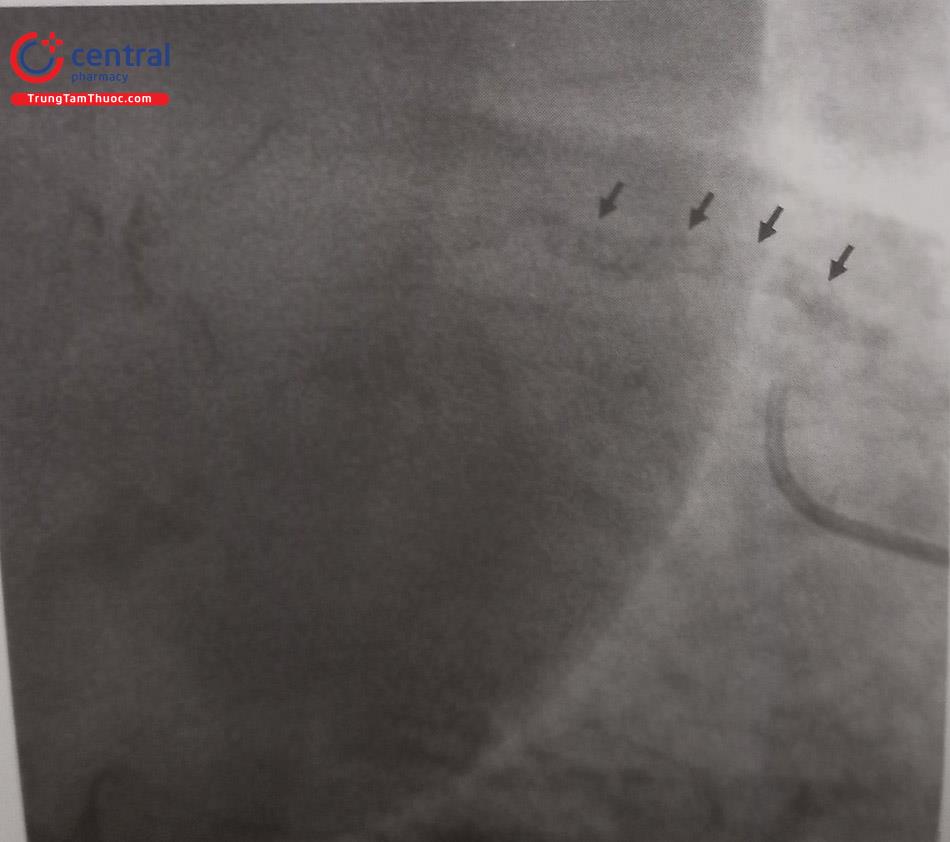 Hình 22.1. Hình ảnh vôi hóa mức độ nặng (mũi tên màu đen) trên phim chụp động mạch vành: hình dải vôi có viền ở hai phía như đường ray.