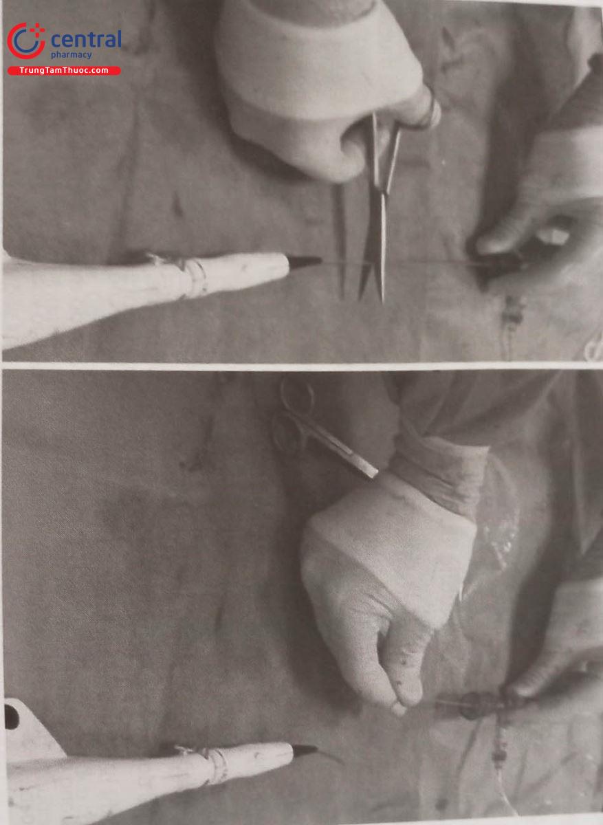 Hình 22.9. Thân mũi khoan được cắt rời và rút bỏ vỏ bọc nhựa để đưa microcatheter hoặc snare vào hỗ trợ kéo mũi khoan bị kẹt ra ngoài