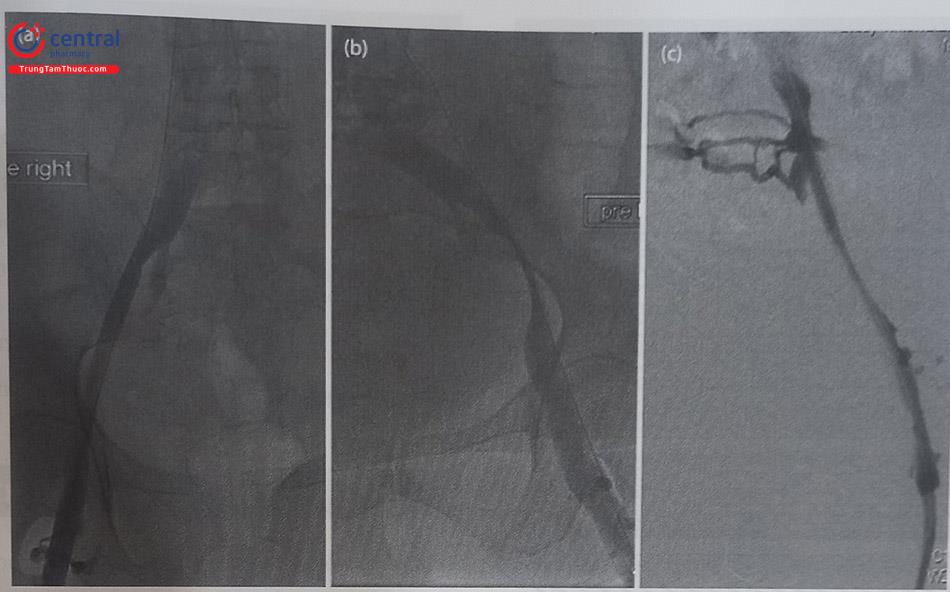 Hình 59.5. Hình ảnh trên phim chụp tĩnh mạch cản quang chỉ ra hẹp lan tỏa toàn bộ tĩnh mạch chậu (a), hẹp khu trú ở tĩnh mạch chậu ngoài (b), tồn tại tĩnh mạch bàng hệ trước đoạn gần tĩnh mạch chậu chung (Theo Erin H.Murphy)