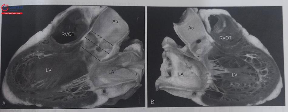 Hình 48.3. Giải phẫu của cung động mạch chủ và đường ra thất trái