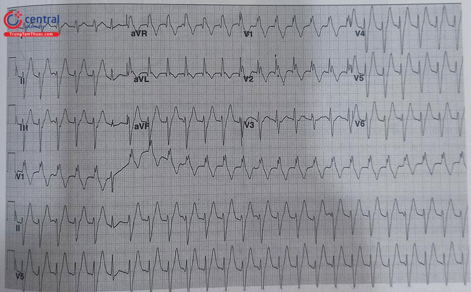 Hình 48.8. Điện tâm đồ cơn tim nhanh thất do vòng vào lại phân nhánh trái sau với V1 dạng block nhánh phải và trục điện tim hướng lên trên