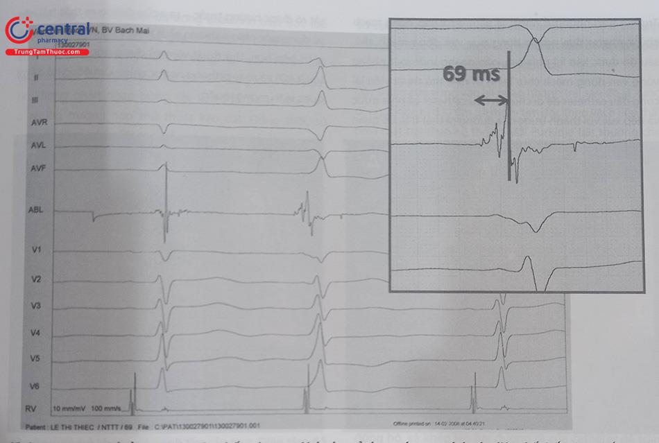 Hình 48.19. Triệt đốt ổ ngoại tâm thu thất tại xoang Valsalva sử dụng phương pháp đo điện thế thất sớm nhất với EAT= 69 ms thu được trên catheter triệt đốt