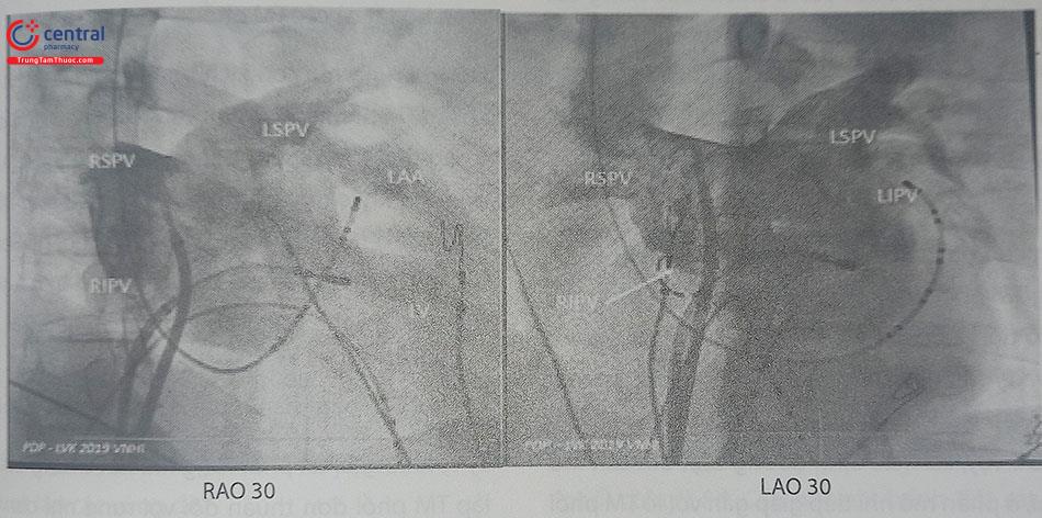 Hình 50.2. Hình chụp nhĩ trái cản quang theo 2 góc chụp nghiêng phải, nghiêng trái với các dây điện cực đặt trong buồng tim