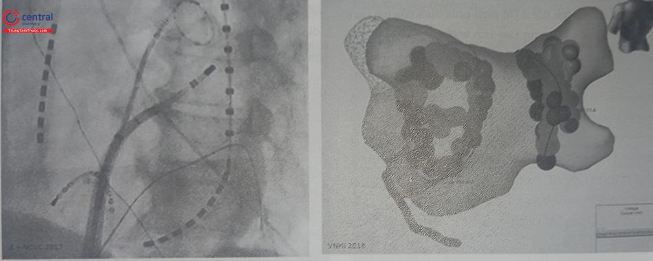 Hình 50.4. Ống thông vòng nhẫn và ống thông triệt đốt trong đốt cô lập TM phổi (hình trái) và các điểm đốt cô lập hoàn thiện 4 tĩnh mạch phổi (hình phải)