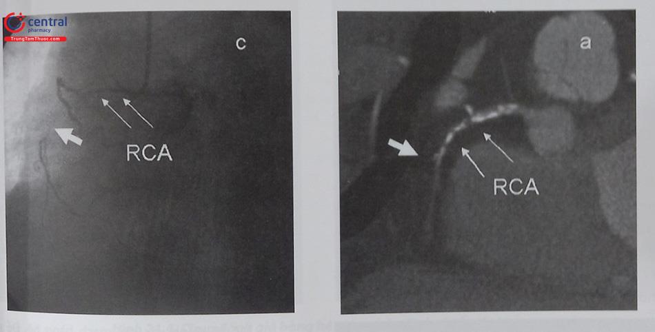 Hình 21.1. Chụp MSCT động mạch vành giúp đánh giá tổn thương CTO trước can thiệp, đặc biệt các tổn thương vôi hóa, hoặc tuần hoàn bàng hệ khó nhìn thấy trên phim chụp qua da