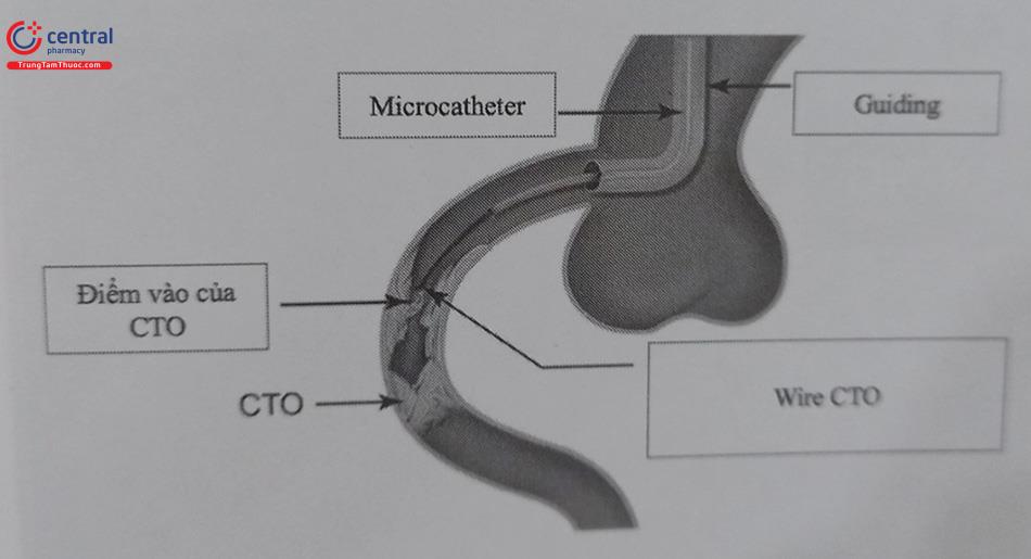 ​​​​​​​Hình 21.8. Microcatheter được đưa qua guiding để đưa wire CTO đến sát tổn thương cho support tốt nhất