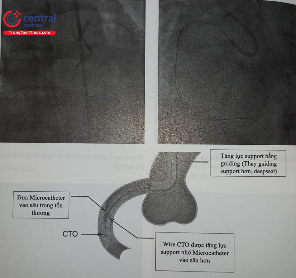 Hình 21.17. Đưa Microcatheter vào sâu, có thể vào cả vùng CTO để tăng lực support cho wire