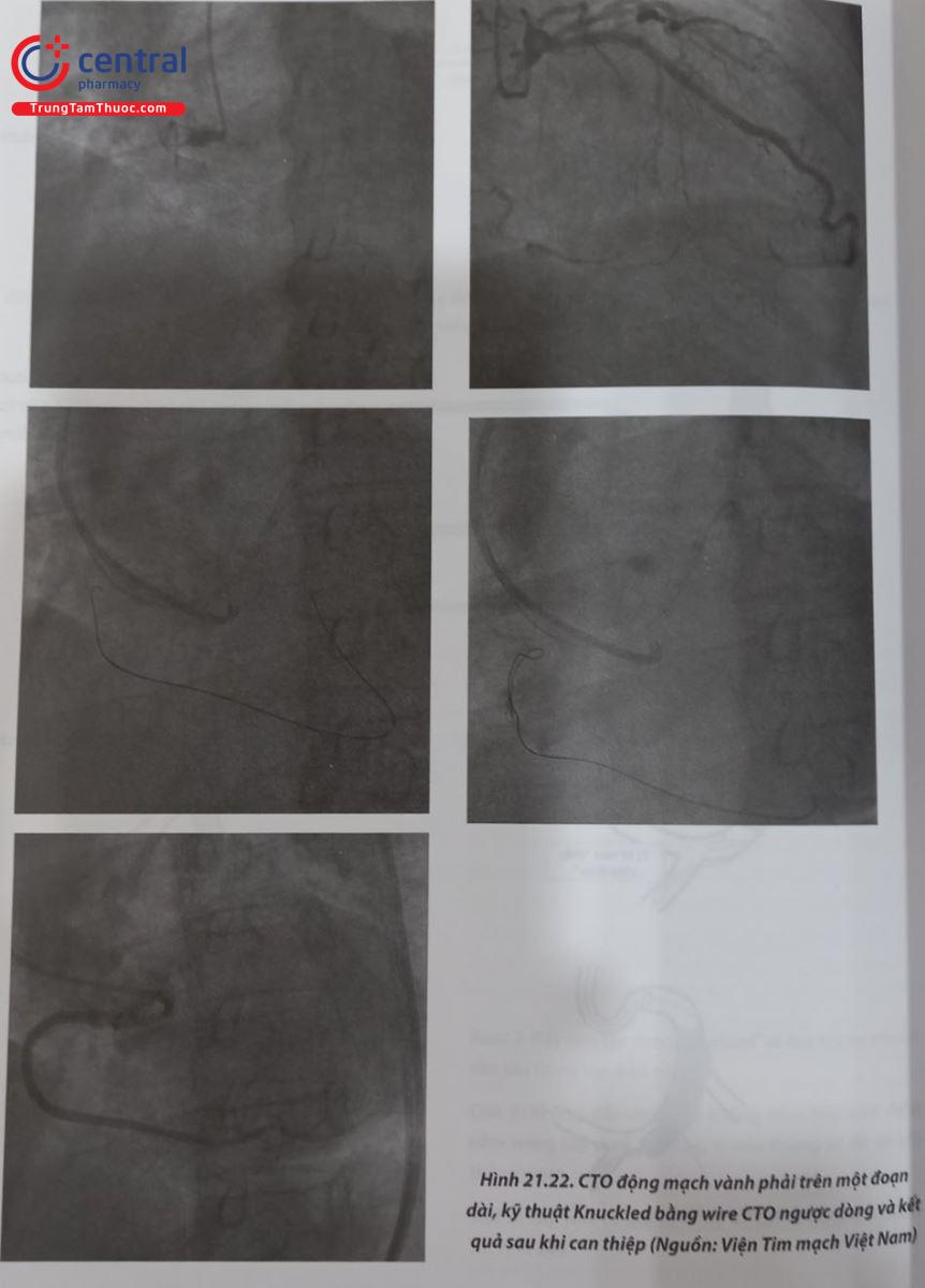 Hình 21.22. CTO động mạch vành phải trên một đoạn dài, kỹ thuật Knuckled bằng wire CTO ngược dòng và kết quả sau khi can thiệp (Nguồn: Viện Tim mạch Việt Nam)