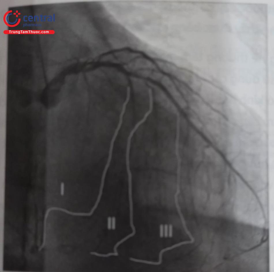 Hình 21.24. Các dạng bàng hệ Septal phổ biến – Bàng hệ Septal là bàng hệ thường dùng nhất để can thiệp ngược dòng