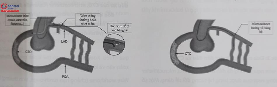 Hình 21.26. Tiếp cận và lái guidewire về hướng bàng hệ được chọn