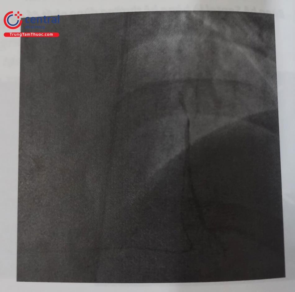 Hình 21.28. Ca Stent cũ động mạch vành phải, CTO động mạch liên thất trước (LAD), can thiệp lần 1 thất bại. Chụp bàng hệ và lái wire ngược dòng qua bàng hệ đến đầu xa của CTO, microcatheter (Caravelle được đưa đến đầu xa của tổn thương, chụp lại để chắc chắn microcatheter nằm ở đầu xa của CTO)