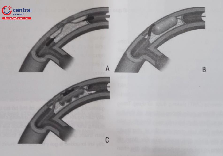 Hình 21.31. Kỹ thuật CART (gây bóc tách và đi wire dưới nội mạc ngược dòng) (A) Wire xuôi dòng và ngược dòng đều nằm trong lớp dưới nội mạc. (B) Nong bóng xuôi dòng với đường kính bóng xấp xỉ mạch máu. (C) Wire ngược dòng đi qua vết rách dưới nội mạc bị xé rách và đi được đến lòng thật đầu gần. Một catheter nối dài có thể được sử dụng để đưa wire qua guiding xuôi dòng (Reverse – CART hỗ trợ bởi GuideLiner)