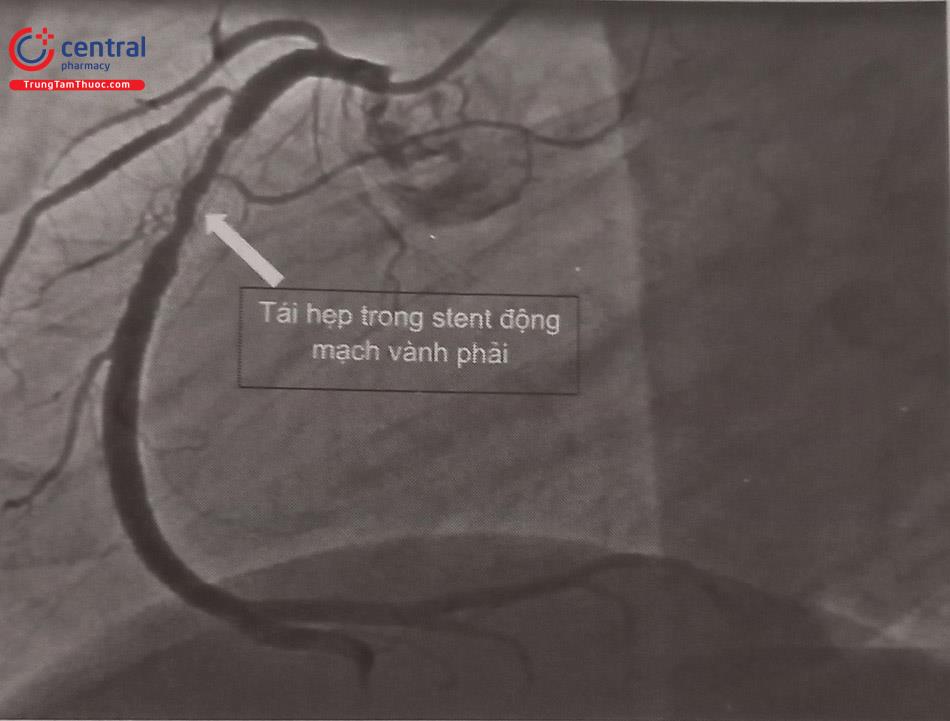 Hình 23.1. Hình ảnh tái hẹp trong stent động mạch vành phải