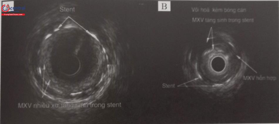 Hình 23.8. Hình ảnh IVUS của tái hẹp trong stent động mạch vành.
