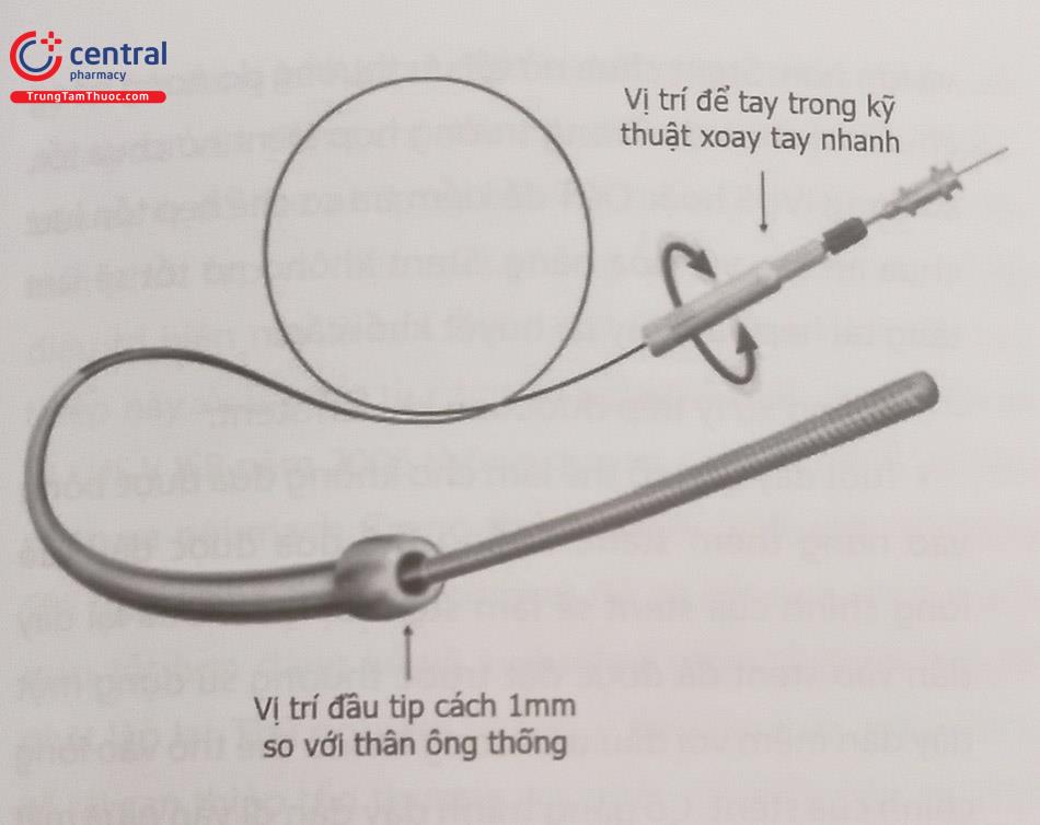 Hình 23.10. Cấu tạo của hệ thống ống thông CrossBoss với kỹ thuật xoay tay nhanh.