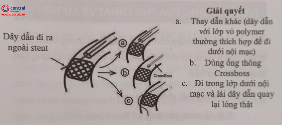 Hình 23.11. Các tình huống xử lý khi dây dẫn can thiệp xuyên qua các mắt stent đi dưới nội mạc