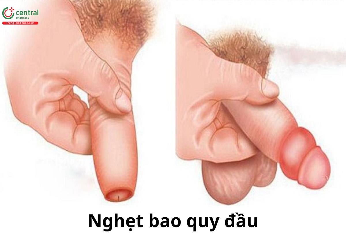 Nghẹt bao quy đầu