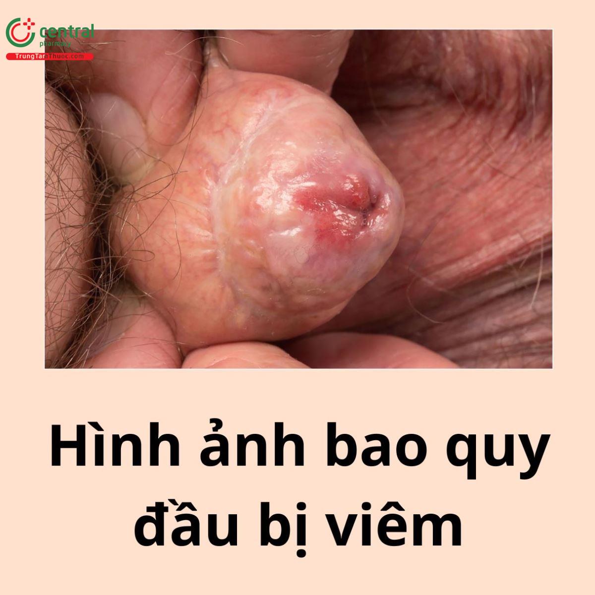 Hình ảnh bao quy đầu bị viêm