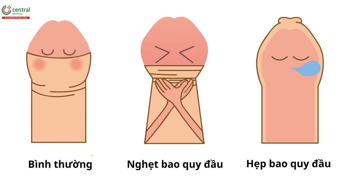 Có nên cắt bao quy đầu cho trẻ không?