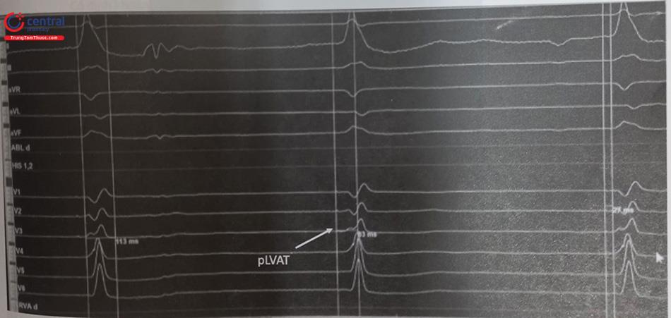 Hình 53.23. Tạo nhịp nhánh trái chọn lọc với V1 dạng sR, Spike-QRS 27 ms, đẳng điện bằng với điện thế nhánh trái-QRS lúc nhịp cơ bản