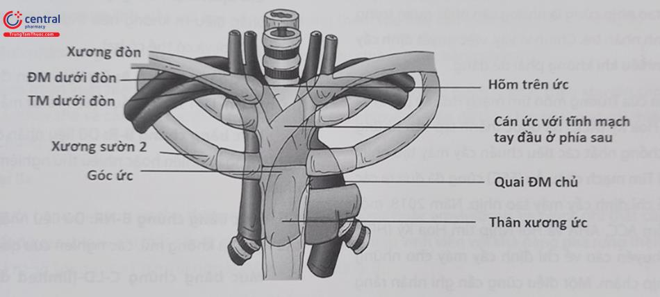 Hình 51.2. Vị trí và đường đi của động mạch, tĩnh mạch nách, động tĩnh mạch dưới đòn, xương đòn, xương sườn thứ nhất và xương ức