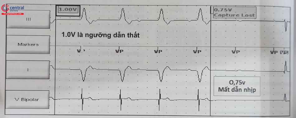 Hình 51.11. Xác định ngưỡng dẫn nhịp