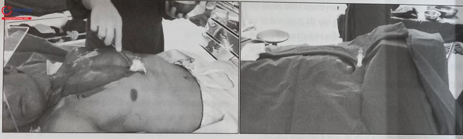 Hình 51.15. Sát trùng vùng cấy máy, đặt tấm mica và che phủ bệnh nhân bằng các tấm vải vô khuẩn