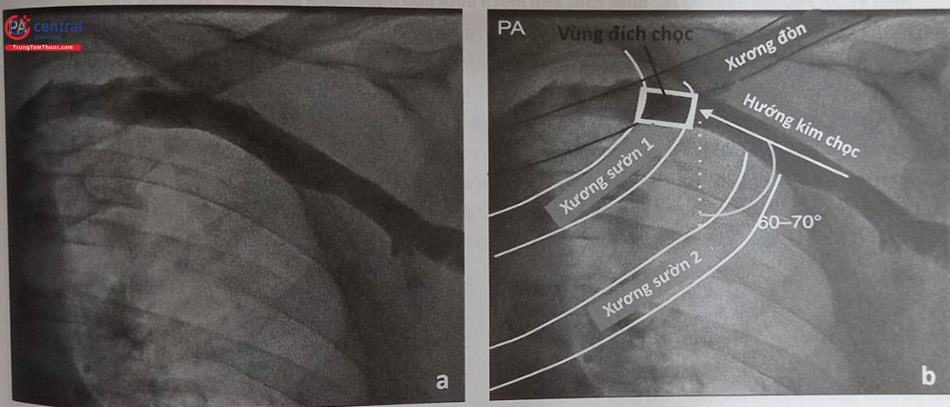 Hình 51.26. Các mốc giải phẫu trên hình ảnh tăng sáng ở tư thế chiếu trước sau (AP) để chọc tĩnh mạch dưới đòn ngoài lồng ngực
