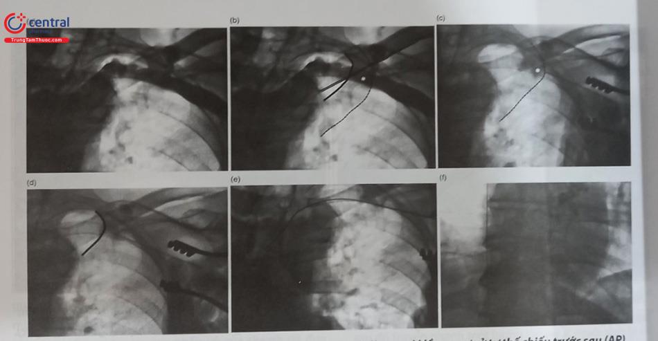 Hình 51.27. Phương pháp và các bước chọc tĩnh mạch dưới đòn ngoài lồng ngực ở tư thế chiếu trước sau (AP)