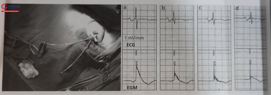 Hình 51.49. Dòng điện tổn thương ghi được ngay sau khi xoáy giãn nở mỏ xoắn cố định điện cực vào cơ tim (dòng dưới) và sau đó dòng điện này giảm dần (a,b,c,d)