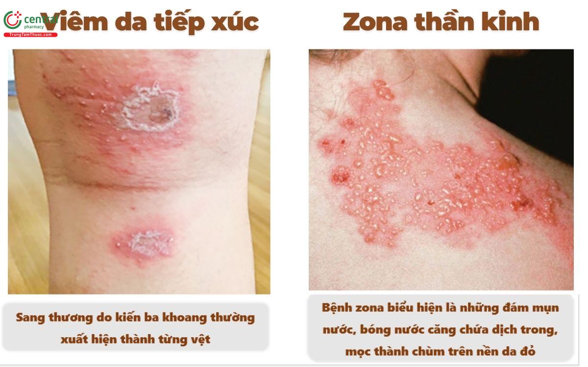 Phân biệt viêm da tiếp xúc dị ứng và zona thần kinh